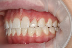 Fig 9. Immediately postoperative photographs showed the final result after composite trimming and polishing. A #12 scalpel was used to trim the gingival margin, and rotary high-speed trimming burs as well as low-speed wheels, points, and disks were used to contour the restoration and create the final luster