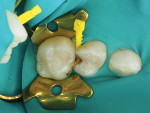 Fig 2. Rubber dam was then placed and the tooth properly isolated for pulpal therapy. The molars were pre-wedged, creating additional separation before preparation and to help prevent iatrogenic damage to the second molar. With pre-wedging, significant debris is often extruded; the wedge also protects the rubber dam and gingival tissues.