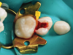 Fig 5. Hemorrhage control was achieved using a ferric sulfate gel (Viscostat™, Ultradent, ultradent.com). Cotton pellets were used to help control the bleeding by applying pressure to the pulp stumps.
FIG 2.
FIG 4.
FIG 3.
FIG 5.