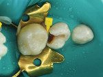 Fig 3. The molar was prepared and the caries removed. The pulp was cariously exposed as predicted by the clinical history and examination.