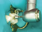 Fig 10. The final restoration placed with gross anatomy was accomplished using a diamond bur, as shown. After rubber dam removal the occlusion was adjusted using a carbide polishing bur.