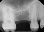 Fig 1. Preoperative periapical radiograph showed the missing maxillary right first molar