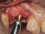 Fig 2. A crestal sinus lift was performed using a crestal sinus approach (CSA) bur and stopper.