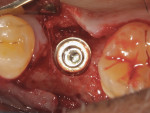 Fig 5. Final implant position. A healing abutment will be placed in lieu of a cover screw.