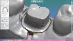 Fig 9. The digital design of the definitive BellaTek Abutment was sent to the referring dentist for approval, then converted to a screw-retained restoration using 3Shape® CAD/CAM (3Shape, 3shape.com).