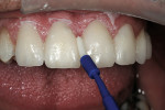 Figure 17  Spot-tacking was followed by clean-up with brushes, scalers, floss, composite knife, and gauze.