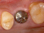 Fig 8. Soft-tissue healing around the BellaTek Encode Healing Abutment was at an acceptable biological level at 4 weeks postoperative.