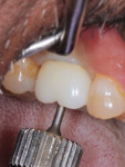 Fig 10. Delivery of a BellaTek Abutment/e.max screw-retained restoration at 5 weeks post-implant placement. The screw was appropriately torqued to recommended levels.