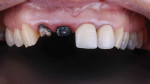 Fig 1. The patient presented with two debonded anterior crowns. She mentioned that her previous endodontist had said tooth No. 8 was infected past the point of being restored and required tooth extraction.