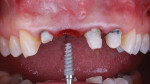 Fig 4. The implant (Hahn Tapered Implant, Ø3.5 mm x 11.5 mm) was placed in the extraction site, with a bias toward the palate. Particulate bone and a resorbable collagen membrane (creos™ xenoprotect, Nobel Biocare, nobelbiocare.com) were placed in the remaining area.