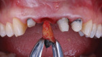 Fig 3. Tooth No. 8 was extracted and the lesion removed. The lesion was encapsulated, signifying the infection was contained and osseointegration may occur.