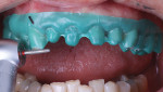 Fig 6. With the use of the Additive-Reductive Template (A.R.T.) provided by DenMat, the teeth were strategically prepared for veneers using this technique’s step-by-step instructions.