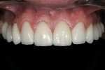 Figure 18  Postoperative visit revealed good soft tissue tolerance and good tooth contours.