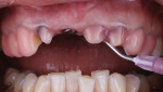 Fig 10. The teeth were prepared for delivery using Etch ’N Seal® (DenMat), Tenure® Multi-Purpose Bonding Solution (DenMat), and Tenure® S Bond Enhancer with Dab-Eze® (DenMat).