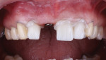Fig 11. Lithium-disilicate crowns were cemented on teeth Nos. 7, 9, and 10 using Infinity® SE self-adhesive, all-purpose cement (DenMat). Excess cement was easily removed in the gel phase. Fig 12. The screw-retained implant crown was placed on tooth No. 8. Lumineers minimally invasive veneers had been placed using Ultra-Bond® Plus (DenMat) and the LumiGrip® Suction Tip (DenMat).