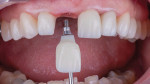 Fig 12. The screw-retained implant crown was placed on tooth No. 8. Lumineers minimally invasive veneers had been placed using Ultra-Bond® Plus (DenMat) and the LumiGrip® Suction Tip (DenMat).