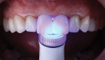 Fig 13. With all final restorations placed, the lithium-disilicate crowns and Lumineers were light-cured in 20-second increments using the Flashlite Magna® 4.0 LED Curing Light (DenMat).