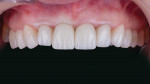 Fig 14. The patient was thrilled with the outcome of her case. The complexity of the case was simplified thanks to DenMat’s products, services, and expertise.