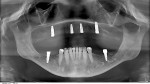Fig 7. Radiograph 1-week post implant placement.