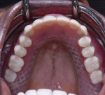 Fig 13. Occlusal view of upper prosthesis in place.