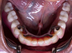 Fig 14. Occlusal view of lower prosthesis in place.