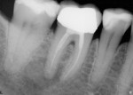 Figure 1  Apical pathology on tooth No. 30, with an inadequate seal at the apex, is clearly evident on a digital radiograph.