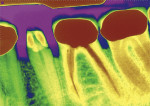 Figure 3  Being able to check the emergence profile of the mandibular premolar (in color) on a digital radiograph is very conducive to a positive outcome.