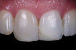 Decreased value of tooth No. 8 seen via macrophotography.