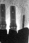 Figure 6  The digital radiograph picked up remaining cement in the sulcus and bone loss around the implant.