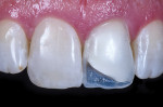 Formed and light-cured composite palatal shell.