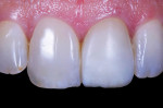 Prepolish critique demonstrating that tooth No. 9 resembles No. 10, not No. 8.