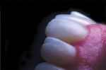 Postoperative view of tooth No. 8 and No. 9, achieving harmony of entire smile via macrophotography and resin artistry.
