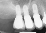 Figure 8  Sinus augmentation with implants is more accurately guided using digital radiography.