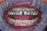 Size No. 1 retraction cord placed around the gingival margins.