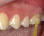 Application of bonding agent on both enamel and dentin.