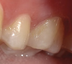Final restoration after polishing, demonstrating excellent blending with surrounding tooth structure and a high luster.