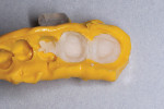 Temporary restoration material in mandibular advancement device.
