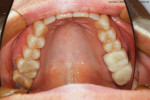 Occlusal view of temporary restoration in the mouth.