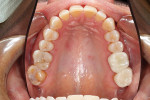 Occlusal view of final restorations in the mouth.