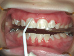 Figure 4  This patient presented with Type 1 periodontal disease following phase 1 orthodontic treatment. The patient received an application of Cervitec Plus Varnish and then was instructed to use EvoraPlus™. Oral hygiene methods were reinforced a