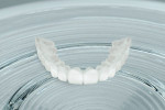 Figure 2  The upper arch of Snap-On Smile.