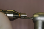 Figure 9  Undercuts are removed with the diamond bur contacting both the tip and shaft simultaneously against the abutment.