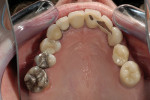 Figure 3  Occlusal view of maxillary arch showing mainly porcelain-surfaced restorations.