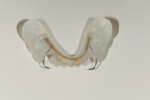Figure 7  Clear orthodontic provisional partial was fabricated with wrought wire clasps at the proposed VDO.