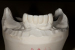 Figure 8  A diagnostic wax-up of the anterior restorations was made at the proposed VDO.