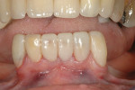 Figure 10  Provisional placed with RAP technique and light-cured flowable direct composite.