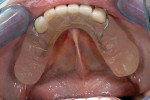 Figure 11  Provisional partial is easily fitted to provisional restorations to maintain occlusal function while waiting on definitive restorations.