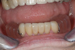 Figure 13  Provisional partial is adapted to veneers while working on permanent removable partial.