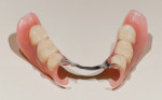 Figure 14  Definitive removable partial design utilized cast lingual major connector and flexible nylon thermoplastic clasps for right and left mandibular canines.