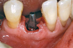Figure 5  The patient’s tooth was removed and the implant was placed.